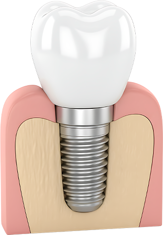 WHAT IS A DENTAL IMPLANT?